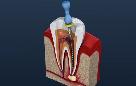 Root Canal (RCT)